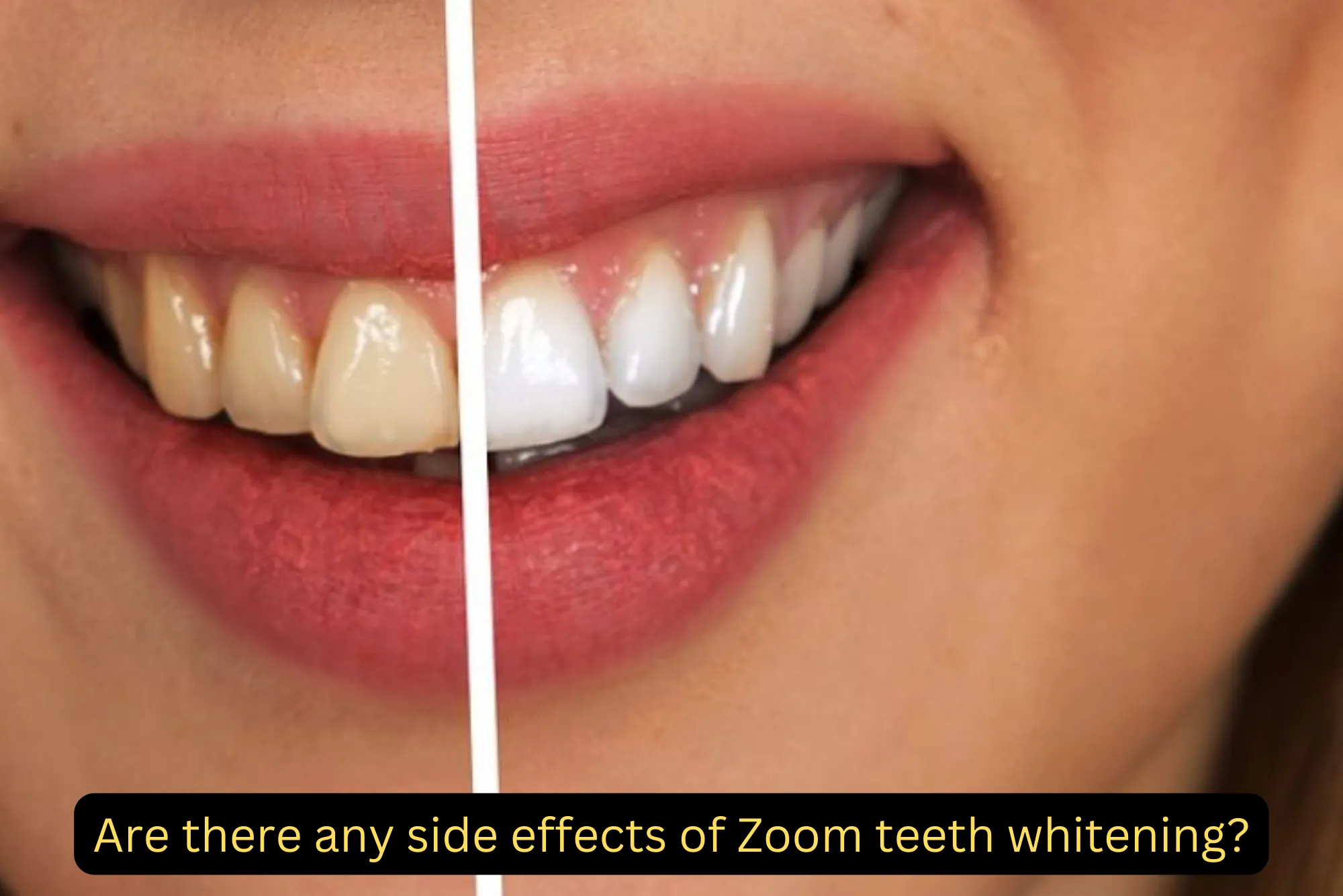 side effects of Zoom teeth whitening